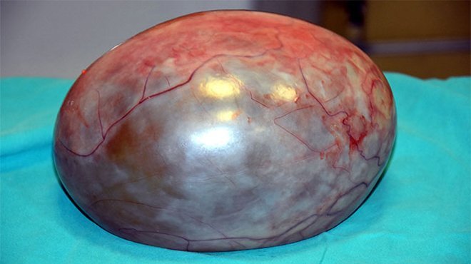 Karnından 3 kilo 400 gram kitle çıktı