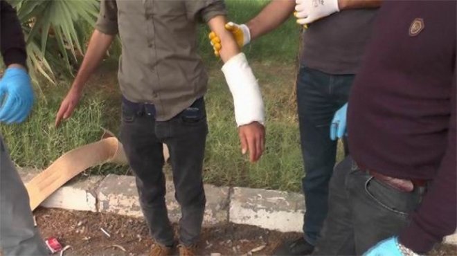 Terörist bombayı kolundaki alçıda kamufle etmiş
